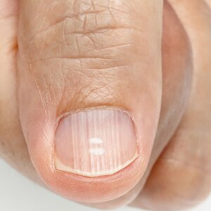 What It Really Means When Ridges Appear On Your Nails