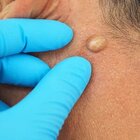 Are Sebaceous Cysts That Big Of A Deal? The Truth