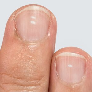 If You Have Ridges On Your Fingernails It Means This