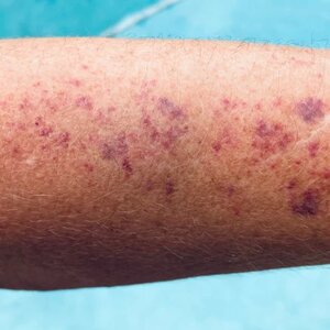 What Is Purpura? Causes, Symptoms, And Treatment