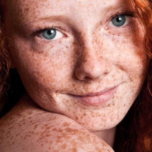 Why Do Some People Have Freckles?