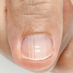 Those Ridges On Your Nails May Be Trying To Tell You Something